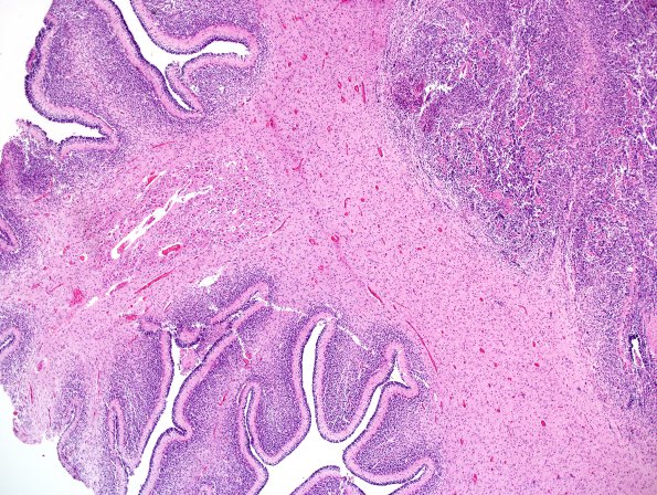 10A7 Cerebellum, Complex malformation (Case 10) 1