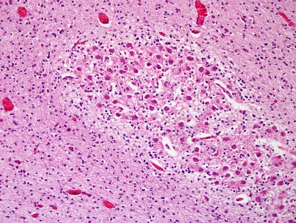 10A8 Cerebellum, Complex malformation (Case 10) 110