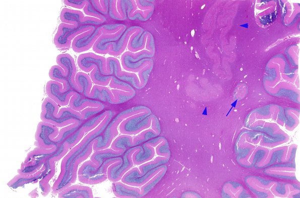 11A1 Heterotopia, cerebellum (Case 11) H&E whole mount