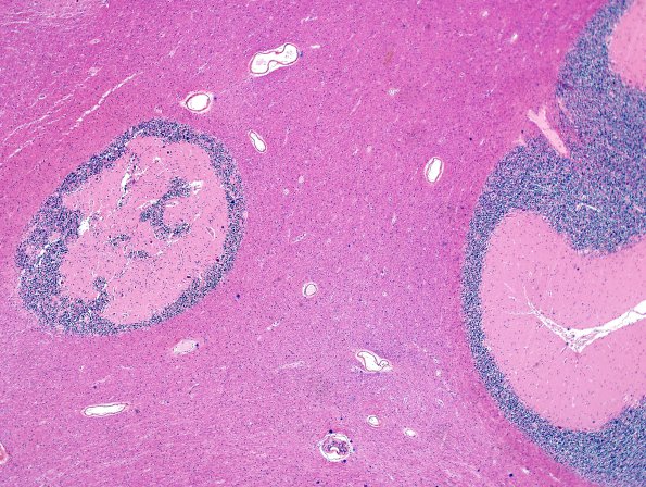 11A2 Heterotopia, cerebellum (Case 11) H&E 3