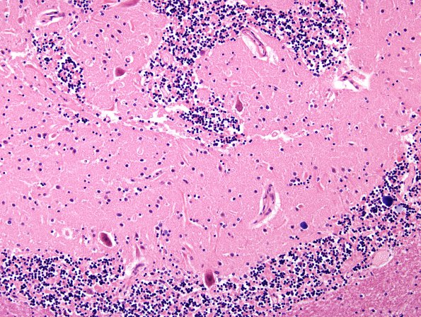 11A4 Heterotopia, cerebellum (Case 11) H&E 1