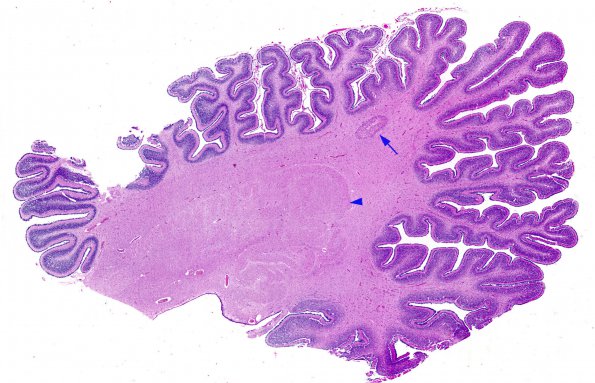 12A1 Cerebellum heterotopia (Case 12) 1