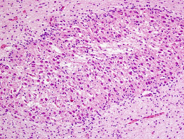 12A2 Cerebellum heterotopia (Case 12) 2