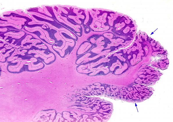 13A1 Cerebellar cortical Dysplasia (Case 13)