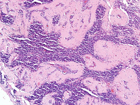 13A2 Cerebellar cortical Dysplasia (Case 13) 1