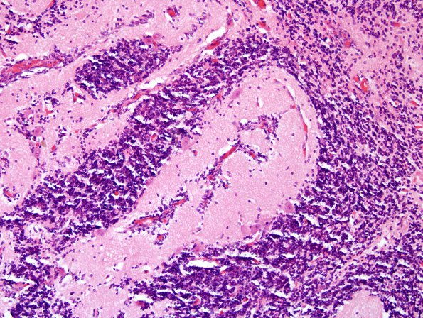 13A3 Cerebellar cortical Dysplasia (Case 13)9