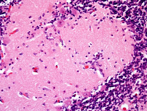 13A4 Cerebellar cortical Dysplasia (Case 13)8