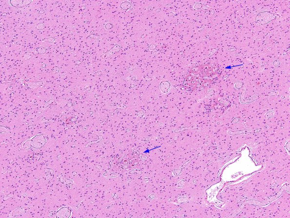 14A1 Heterotopia, cerebellum (Case 14) H&E 1