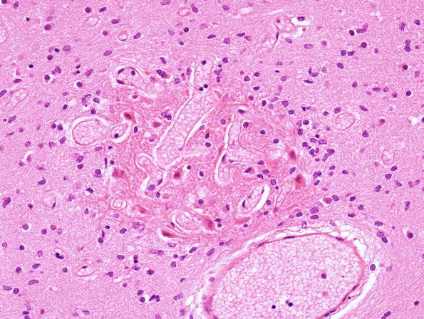 14A2 Heterotopia, cerebellum (Case 14) H&E 2