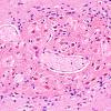 14A3 Heterotopia, cerebellum (Case 14) H&E 3