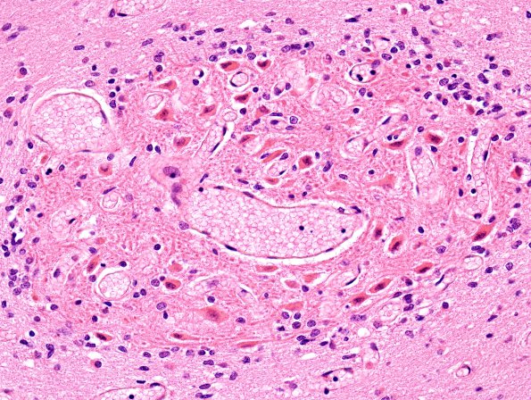 14A3 Heterotopia, cerebellum (Case 14) H&E 3