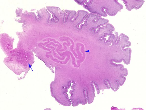 15 Cerebellum dentate (Case 15) H&E whole mount