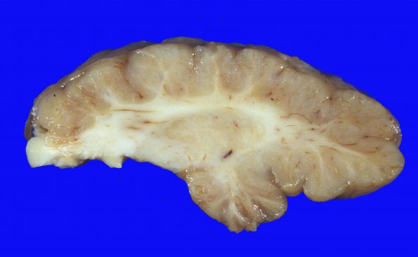 16 Cerebellum heterotopia-dysplasia (Case 16) aA