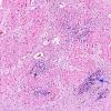 1A4 Malformation, dentate nucleus (Case 1) H&E 1