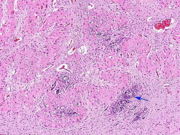 1A4 Malformation, dentate nucleus (Case 1) H&E 1