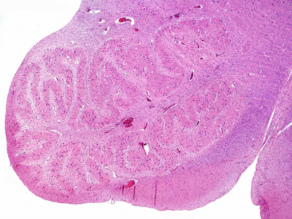 1A5 Olivary Malformation (Case 1) H&