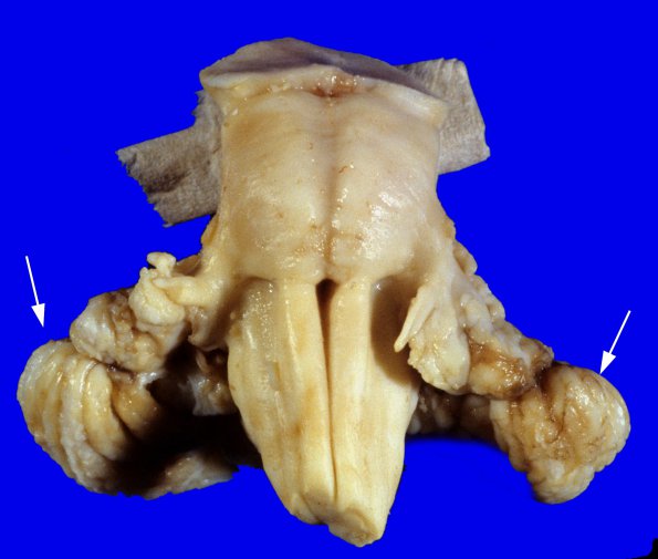 2A1 Pontoneocerebellar Hypoplasia & Werdnig-Hoffman Dz (Case 2) 2A