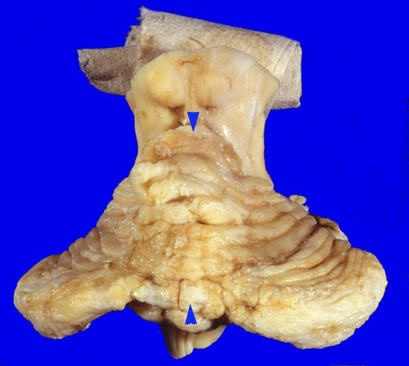 2A2 Pontoneocerebellar Hypoplasia & Werdnig-Hoffman Dz (Case 2) 1A