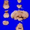 2A3 Pontoneocerebellar Hypoplasia & Werdnig-Hoffman Dz (Case 2) 4A