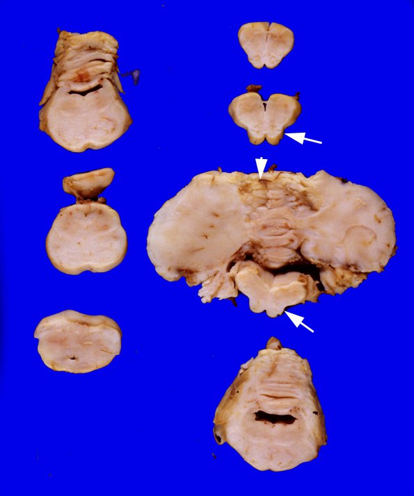 2A3 Pontoneocerebellar Hypoplasia & Werdnig-Hoffman Dz (Case 2) 4A