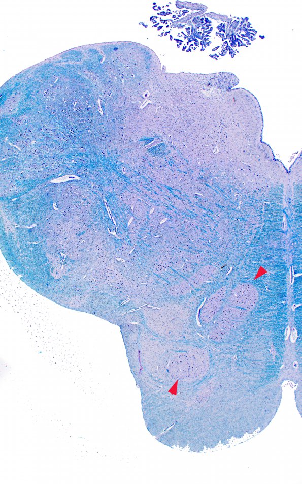 2B1 Pontoneocerebellar Hypoplasia & Werdnig-Hoffman Dz (Case 2) 4