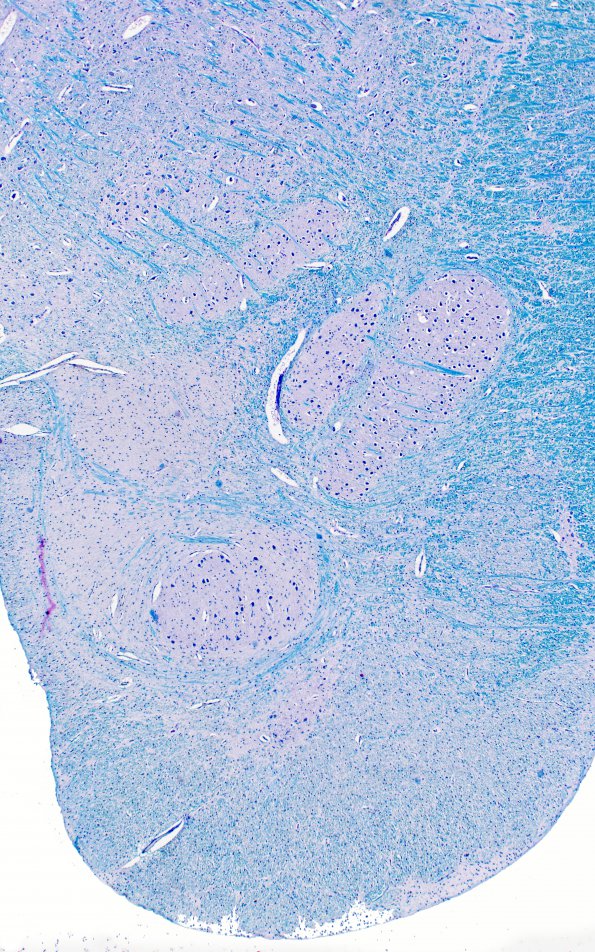 2B2 Pontoneocerebellar Hypoplasia & Werdnig-Hoffman Dz (Case 2) 4