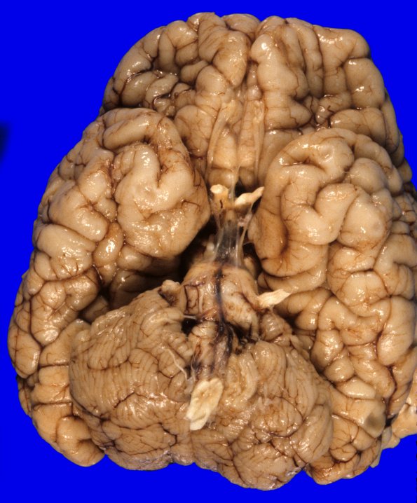 3A1 Cerebellum Malformation (Case 3) 1A