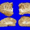 3A2 Cerebellum Malformation (Case 3) 3,Heterotopia-Dysplasia A