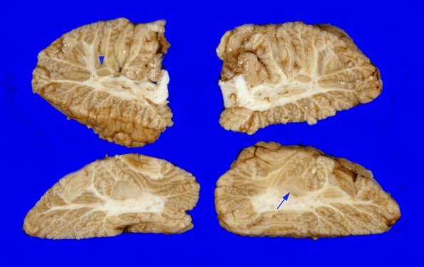 3A2 Cerebellum Malformation (Case 3) 3,Heterotopia-Dysplasia A