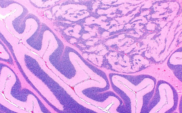 3B Mixed cell rest - Dysplasia (Case 3) 1