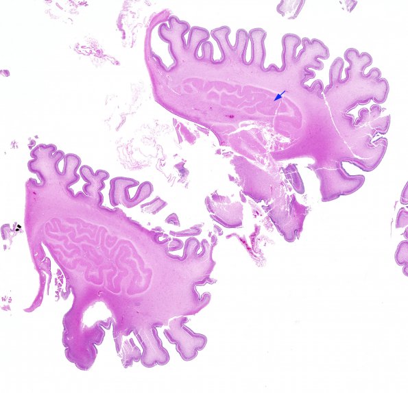 4A1 Cerebellum dentate (Case 4) H&E whole mount