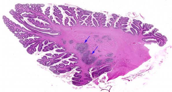 5A1 Cerebellum heterotopia (Case 5)  1