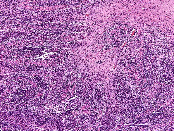 5A3 Cerebellar dysplasia (Case 5) 5