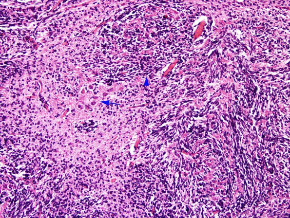 5A4 Cerebellar Dysplasia (Case 5) Trisomy 13