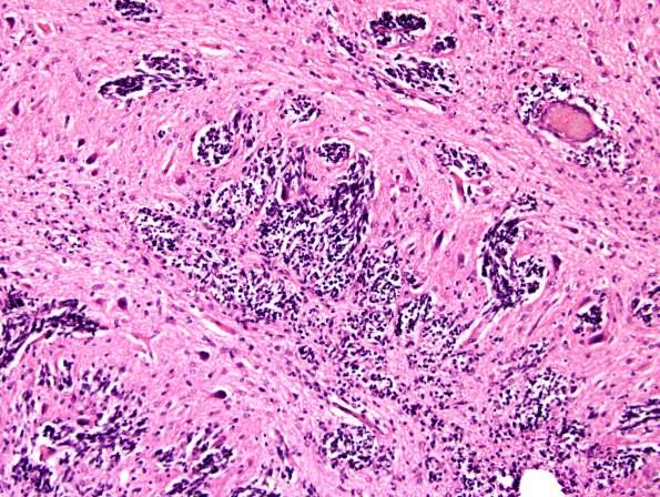 5A5 Cerebellar dysplasia (Case 5) 7