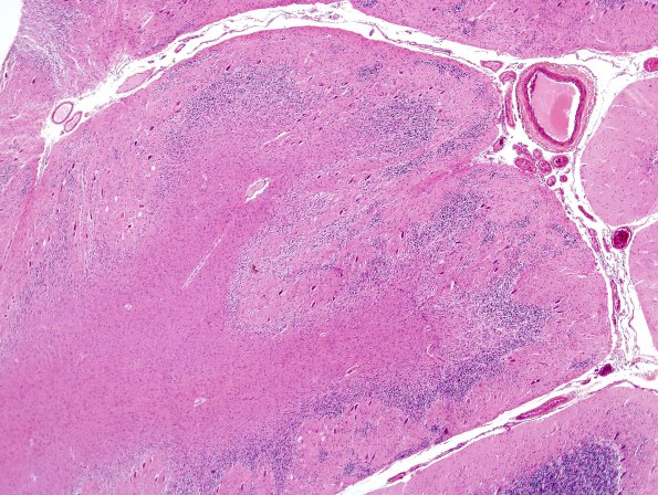 6A1 Dysplasia, cerebellum (Case 6) H&E 4