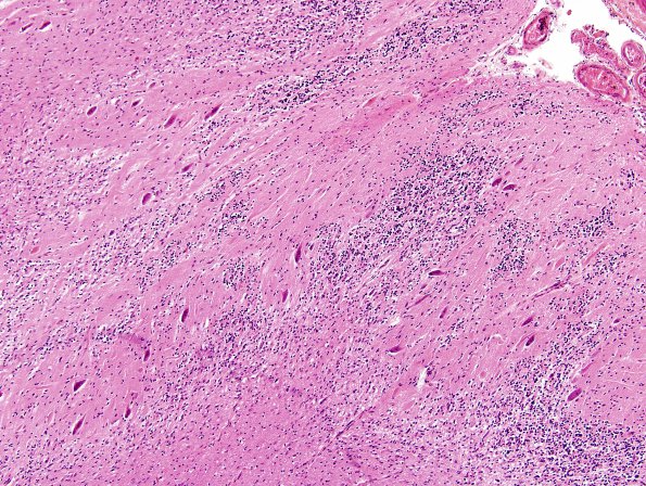 6A2 Dysplasia, cerebellum (Case 6) H&E 3