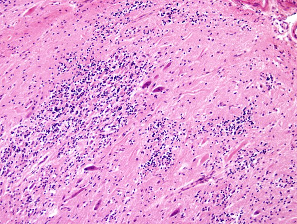 6A3 Dysplasia, cerebellum (Case 6) H&E 1