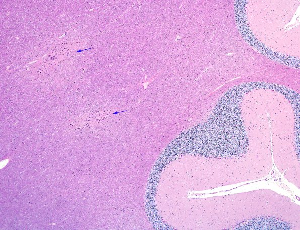 7A1 Heterotopia with globules, cerebellum (Case 7) H&E 3