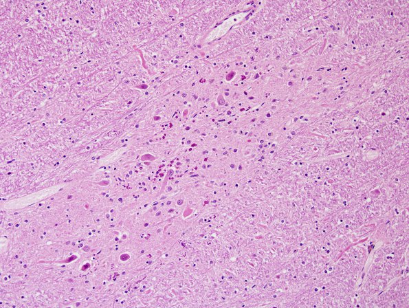 7A2 Heterotopia with globules, cerebellum (Case 7) H&E 5