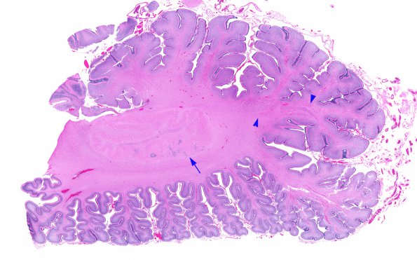 8A1 Heterotopia, cerebellum (Case 8) H&E whole mountA