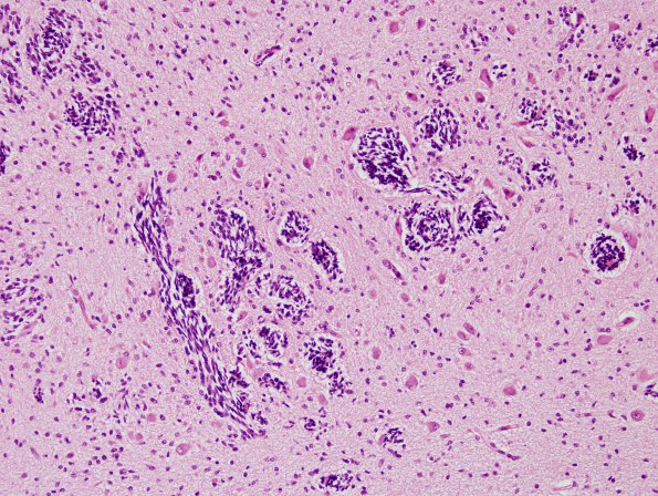 8A2 Dysplasia, cerebellum (Case 8) H&E 4