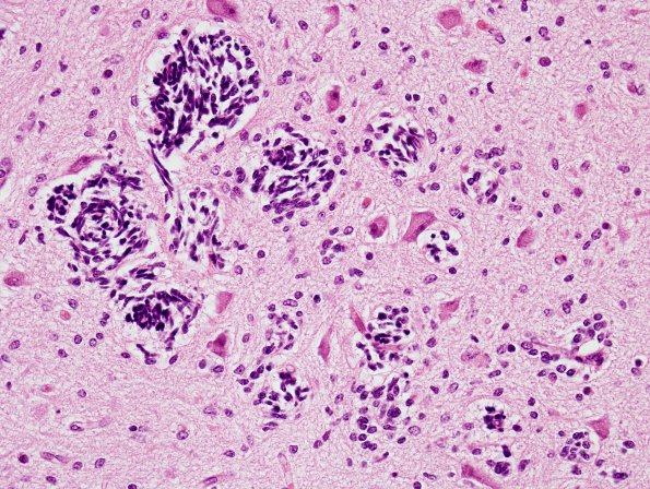 8A3 Immature neurons, cerebellum (Case 8) H&E 1