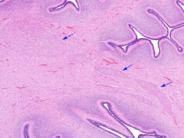 8A4 Heterotopia, cerebellum (Case 8) H&E 4A