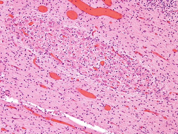 8A5 Heterotopia, cerebellum (Case 8) H&E 4