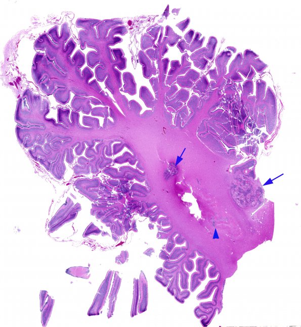 9A1 Malformations, cerebellar (Case 9) H&E whole mount