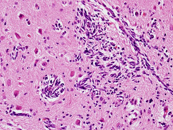 9A2 Malformations, cerebellar (Case 9) H&E 1