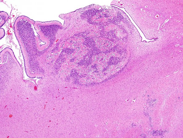 9A3 Malformations, cerebellar (Case 9) H&E 5