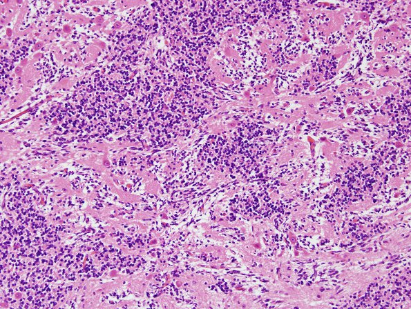 9A4 Malformations, cerebellar (Case 9) H&E 4