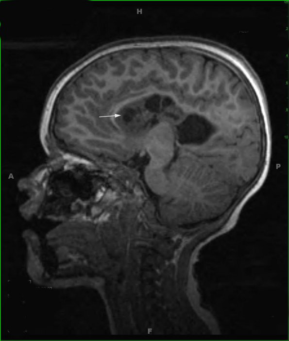 1A1 Malformation, complex Het PMG (Case 1) T1 MPRAGE